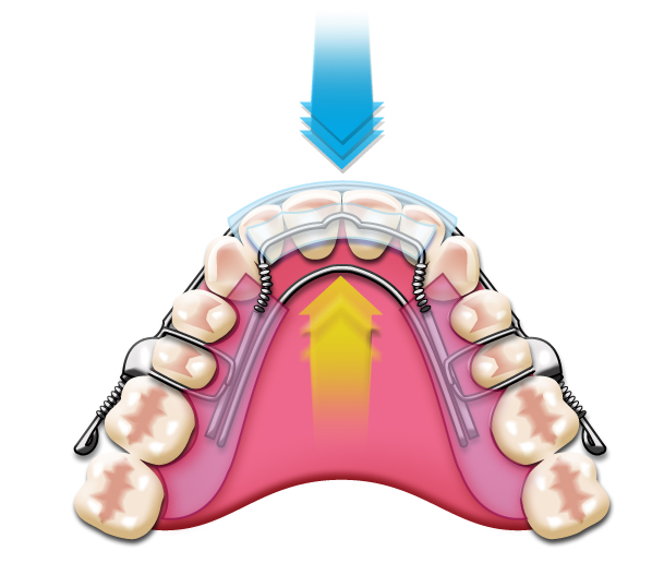 Nevidni zobni aparat – revolucionarni ortodontski pripomoček