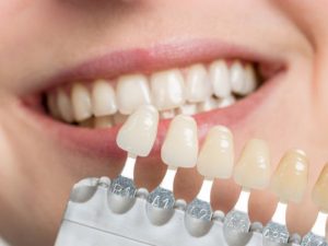 Prednosti zobnih lusk
