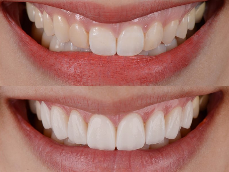 Zobne luske iz kompozitne smole je treba zamenjati prej, saj trajajo približno 4 do 8 let.