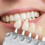 Prednosti zobnih lusk