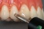 Parodontoza kot posledica vnetja zob